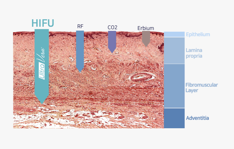 질쎄라 시술이미지