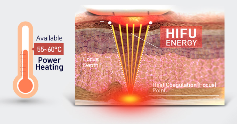 질쎄라 시술이미지