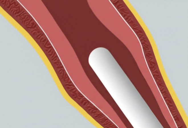 질쎄라 시술이미지