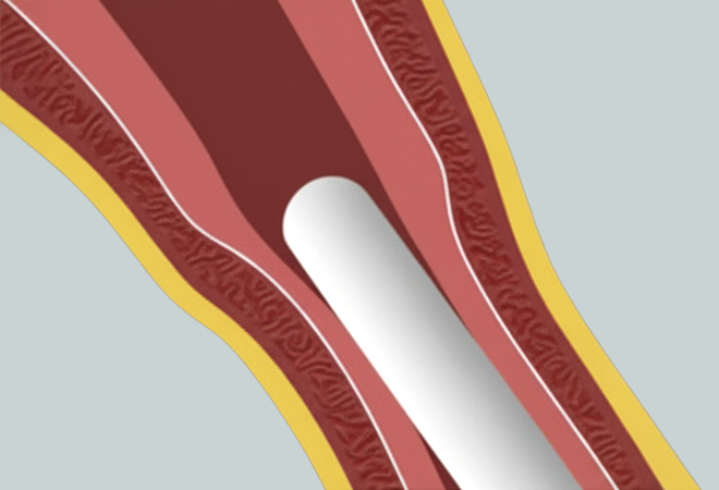 질쎄라 시술이미지