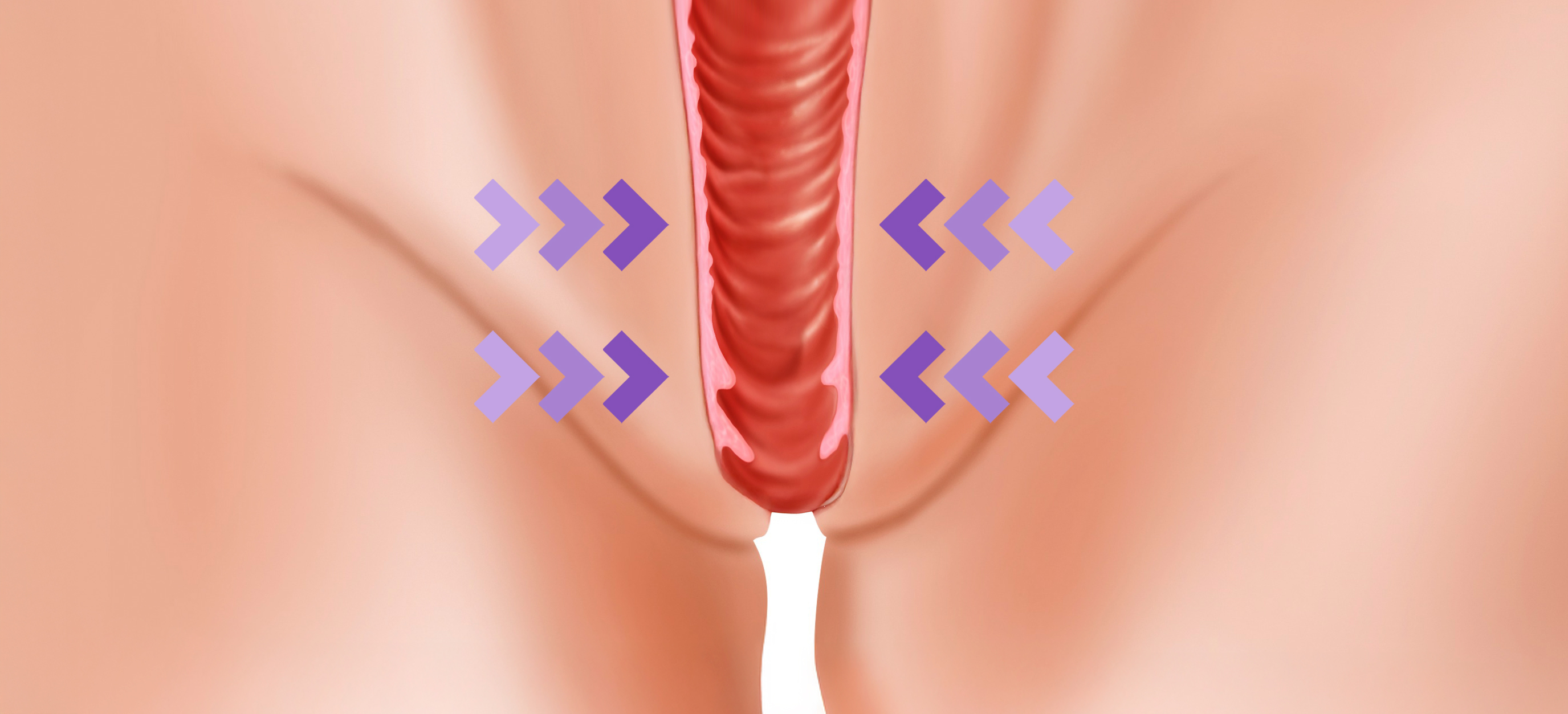 질쎄라 시술이미지