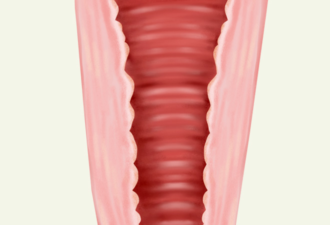 질쎄라 시술이미지