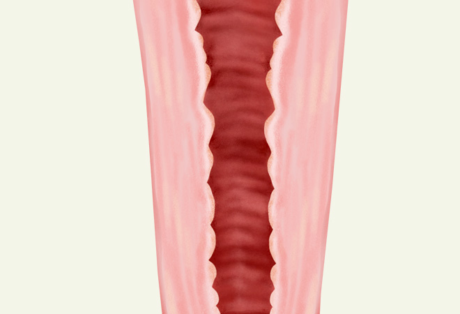 질쎄라 시술이미지