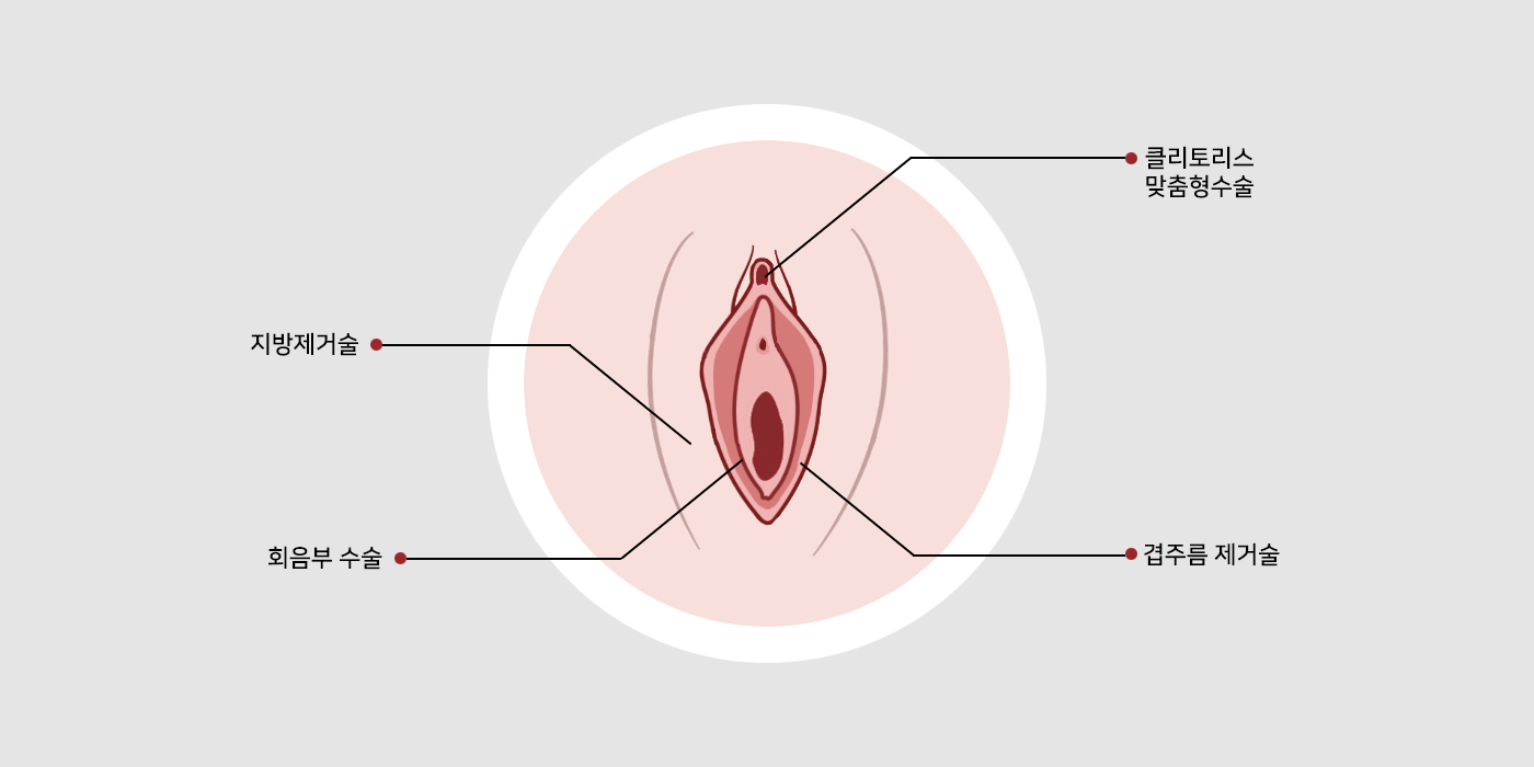 질쎄라 시술이미지