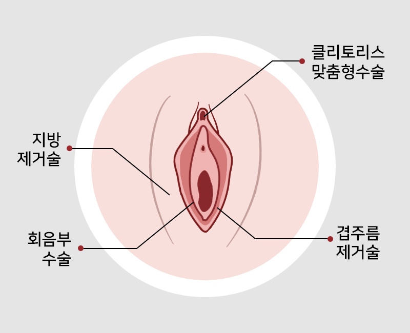 질쎄라 시술이미지
