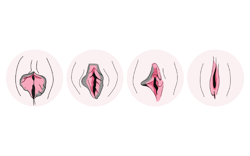 질쎄라 시술이미지