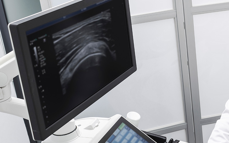 질쎄라 시술이미지